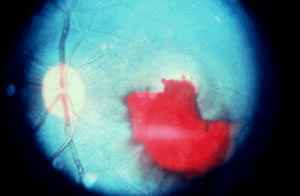 Red color showing vitreal hemorrhage of an eye