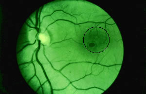 Large retinal burn from diffuse laser exposure Area of retinal burn